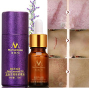 Scar Skin Repair Essential Oil Lavender Care Natural Skin Pure Remove Ance Burn Strentch Marks Removal Scar 10 ML