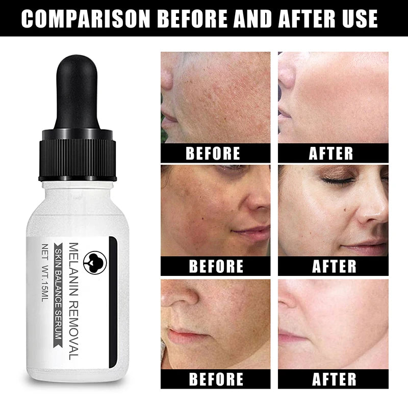 Niacinamide Serum Remove Dark Spots Freckle Whitening Moisture Powerful Removal Melasma Chloasma Black Dot Cream Face Skin Care